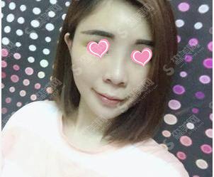 整形专家胡晓根医生怎么样?胡晓根医生的技术能力盘点+面部脂肪填充的果恢复图展示