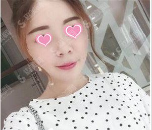 整形专家胡晓根医生怎么样?胡晓根医生的技术能力盘点+面部脂肪填充的果恢复图展示