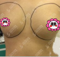 整形专家李比医生怎么样?李比医生的技术实力盘点+脂肪隆胸的恢复果图