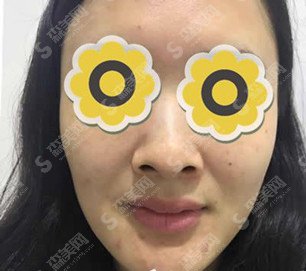 整容鼻子的整形价目表2021，隆鼻以后的果是怎么样？内附整容隆鼻项目较新价目表