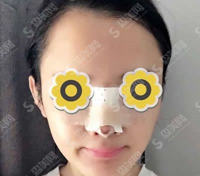 整容鼻子的整形价目表2021，隆鼻以后的果是怎么样？内附整容隆鼻项目较新价目表