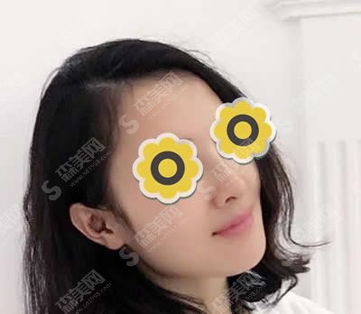 整容鼻子的整形价目表2021，隆鼻以后的果是怎么样？内附整容隆鼻项目较新价目表