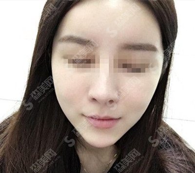 张如鸿医生怎么样?张如鸿医生的技术实力怎么样?颌面整形的术后果怎么样?