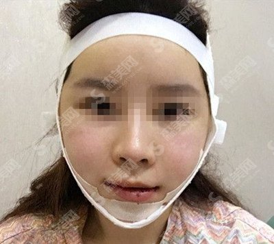 张如鸿医生怎么样?张如鸿医生的技术实力怎么样?颌面整形的术后果怎么样?