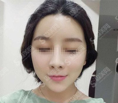 张如鸿医生怎么样?张如鸿医生的技术实力怎么样?颌面整形的术后果怎么样?