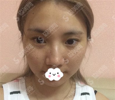 张箐整形医生的口碑怎么样?张箐医生的技术实力好不好/内附激光美肤祛斑案例的果图