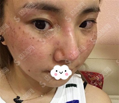 张箐整形医生的口碑怎么样?张箐医生的技术实力好不好/内附激光美肤祛斑案例的果图