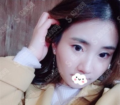 张箐整形医生的口碑怎么样?张箐医生的技术实力好不好/内附激光美肤祛斑案例的果图