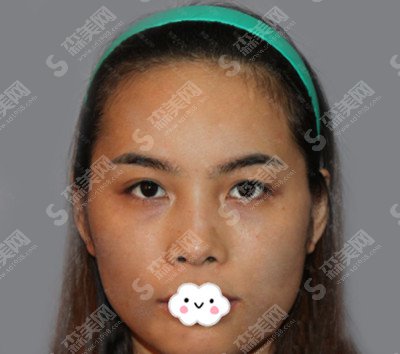 张天宝整形医生是怎么样的?张天宝医生的技术实力盘点+双眼皮的术后果恢复图分享