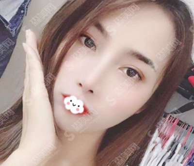 张天宝整形医生是怎么样的?张天宝医生的技术实力盘点+双眼皮的术后果恢复图分享