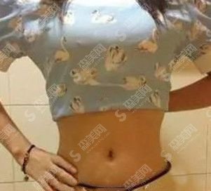 张晓威医生是怎样的?张晓威医生的技术实力盘点+腰腹吸脂的手术果案例图