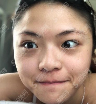 张亦医生怎么样?张亦医生的技术实力盘点+外切去眼袋的术后果恢复图