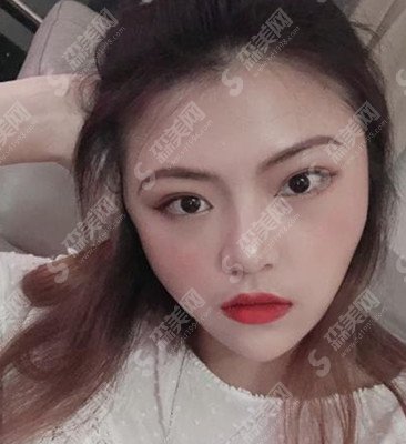 张亦医生怎么样?张亦医生的技术实力盘点+外切去眼袋的术后果恢复图