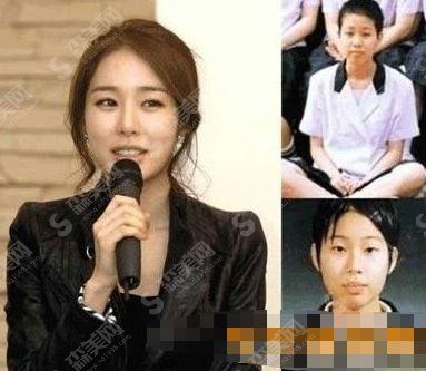 刚看到刘仁娜整容前后照片对比,让我找到了上海华美进行面部吸脂手术