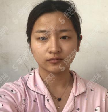 刚看到刘仁娜整容前后照片对比,让我找到了上海华美进行面部吸脂手术