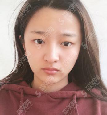 刚看到刘仁娜整容前后照片对比,让我找到了上海华美进行面部吸脂手术