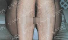 镇江江滨医院整形科价目表2021，内含激光脱毛案例果