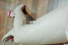 镇江江滨医院整形科价目表2021，内含激光脱毛案例果