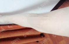 镇江江滨医院整形科价目表2021，内含激光脱毛案例果