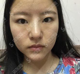 海口瑞韩整形医院价目表2021，内含切开双眼皮的一个果图对比