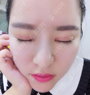 海口瑞韩整形医院价目表2021，内含切开双眼皮的一个果图对比