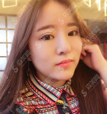 海口瑞韩整形医院价目表2021，内含切开双眼皮的一个果图对比