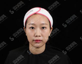 烟台华怡整形医院价格表2021,内含玻尿酸隆鼻案例果图