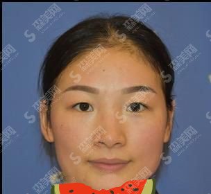 双眼皮全割整形价目表2021,双眼皮全割的果好不好?内附较新双眼皮全割的价目表