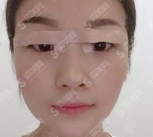 双眼皮全割整形价目表2021,双眼皮全割的果好不好?内附较新双眼皮全割的价目表
