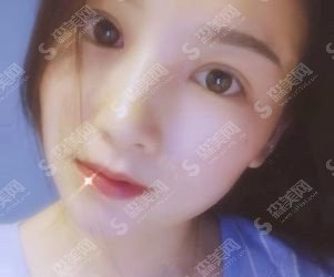 双眼皮全割整形价目表2021,双眼皮全割的果好不好?内附较新双眼皮全割的价目表