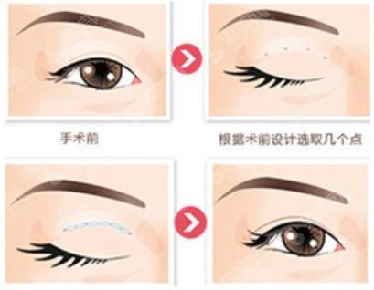 全切双眼皮手术的价格？附全切双眼皮案例+前后果对比图