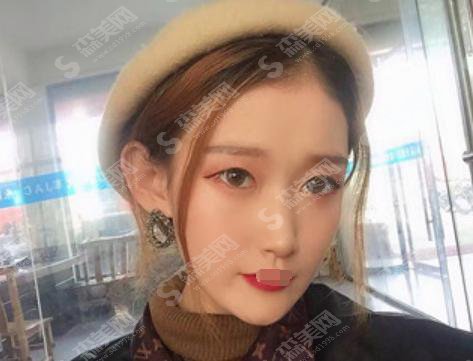 全切双眼皮手术的价格？附全切双眼皮案例+前后果对比图