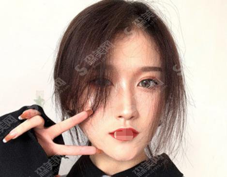 全切双眼皮手术的价格？附全切双眼皮案例+前后果对比图