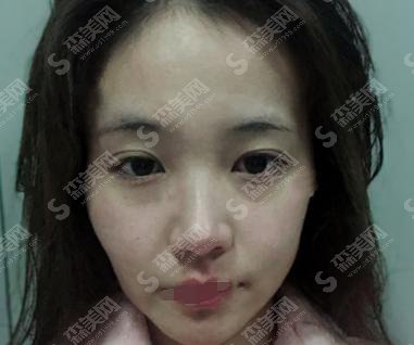 脸部脂肪填充的价格?附脸部脂肪填充案例+前后果对比图