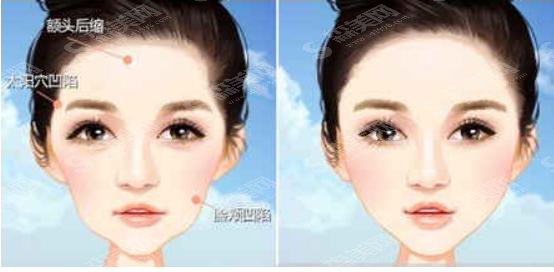 脸部脂肪填充的价格?附脸部脂肪填充案例+前后果对比图