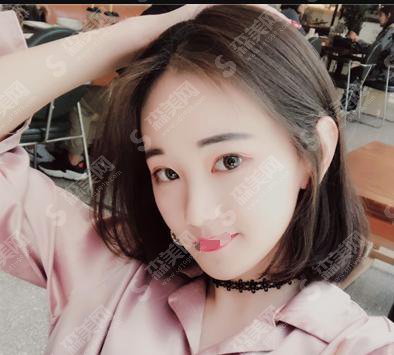 脸部脂肪填充的价格?附脸部脂肪填充案例+前后果对比图