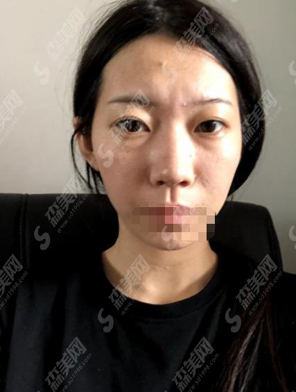 深圳人民医院整形科怎么样？深圳人民医院做的鼻子怎么样？附医师介绍及整形案例