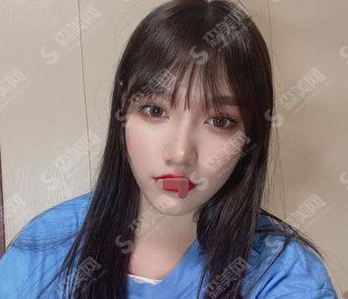 面部脂肪填充的价格?附面部脂肪填充案例+前后果对比图