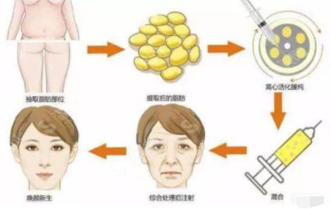 面部脂肪填充的价格?附面部脂肪填充案例+前后果对比图