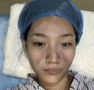 面部脂肪填充的价格?附面部脂肪填充案例+前后果对比图