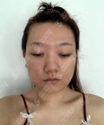 西安高一生整形美容医院价目表2021，内含软骨隆鼻案例前后对比图