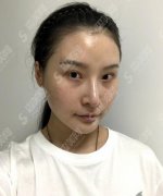 友谊医院美容科价格2021，附面部吸脂案例果图对比照