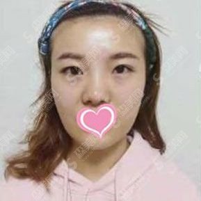 上海九院整形价目表2020大拉皮多少钱?真人案例前后果图