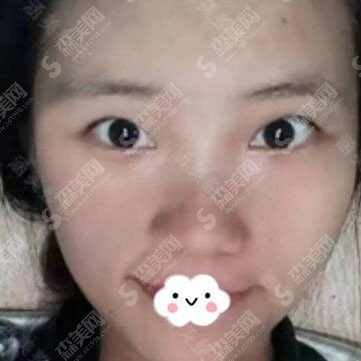 全切双眼皮的整形价格表2020,全切双眼皮的果怎么样？内附较先的双眼皮手术价目表