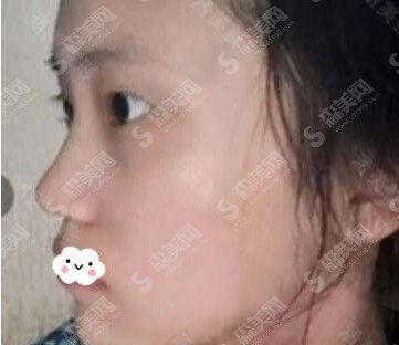 全切双眼皮的整形价格表2020,全切双眼皮的果怎么样？内附较先的双眼皮手术价目表