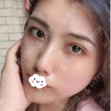 全切双眼皮的整形价格表2020,全切双眼皮的果怎么样？内附较先的双眼皮手术价目表