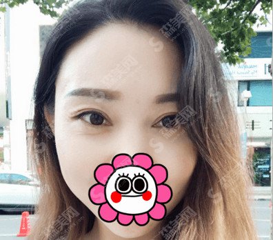 埋线双眼皮整形手术的价目表2020,埋线的双眼皮果好不好?内附双眼皮的较新整形价目表