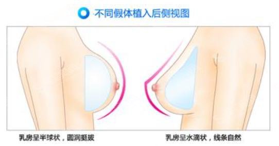 隆胸的价格?附隆胸案例+前后果对比图