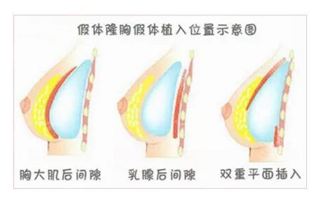 隆胸的价格?附隆胸案例+前后果对比图