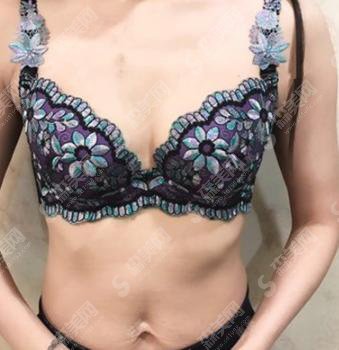 隆胸的价格?附隆胸案例+前后果对比图